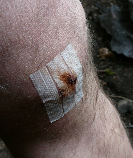 Bills_Knee_stitches_out_resized.jpg