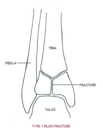 pilon_fracture1.jpg