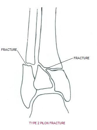 pilon_fracture2.jpg