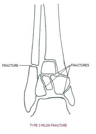 pilon_fracture3.jpg