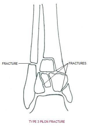 pilon_fracture3.jpg