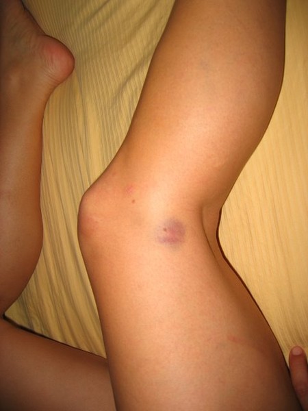 legbruisejune2006.jpg