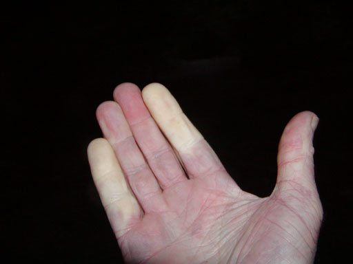 1417RAYNAUDS2.JPG