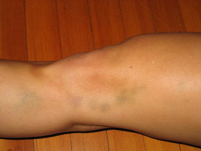bruise1.jpg