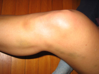 bruise2.jpg